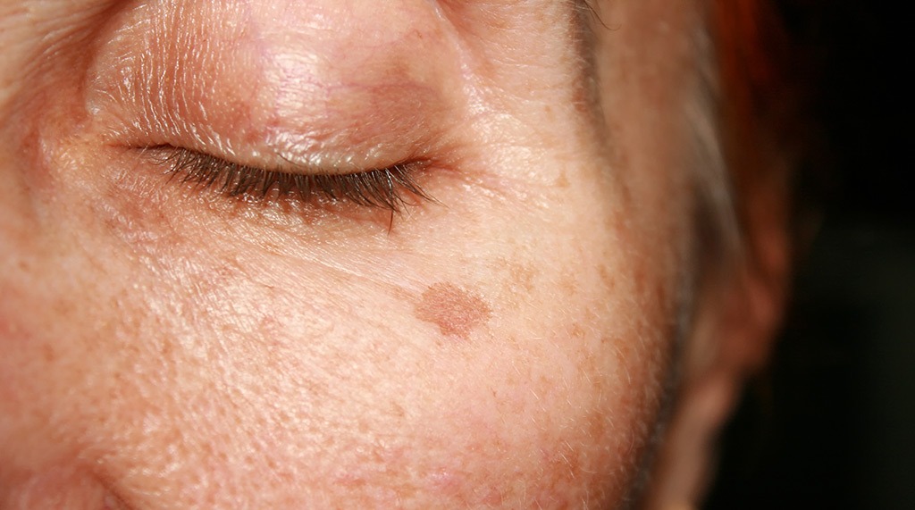 Sun Damage and Brown Spots