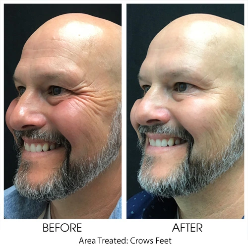 Botox for Crow's Feet