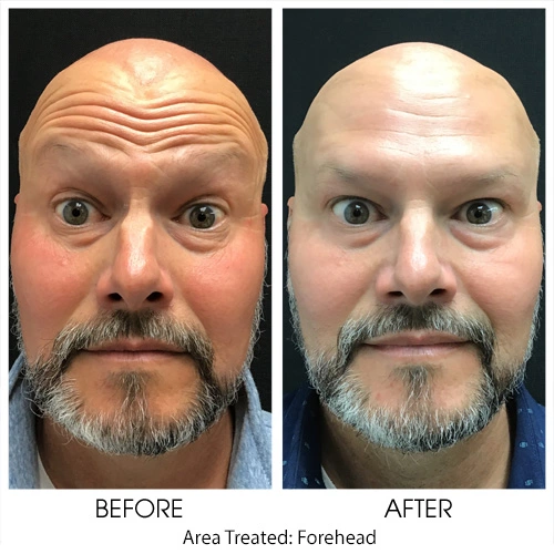 BOT_Forehead12_500px (3) Brotox