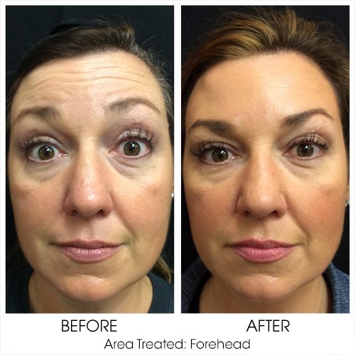 Botox Cosmetic Service Lebo Skin Care York And Hanover 