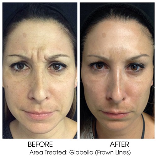 PRP with Cosmetic Filler