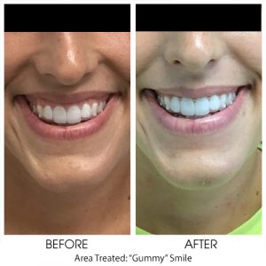 Botox for Gummy Smile