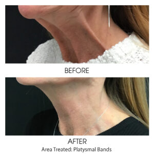 Botox for Neck