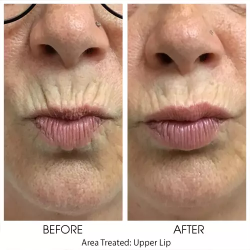 Lip Flip Results
