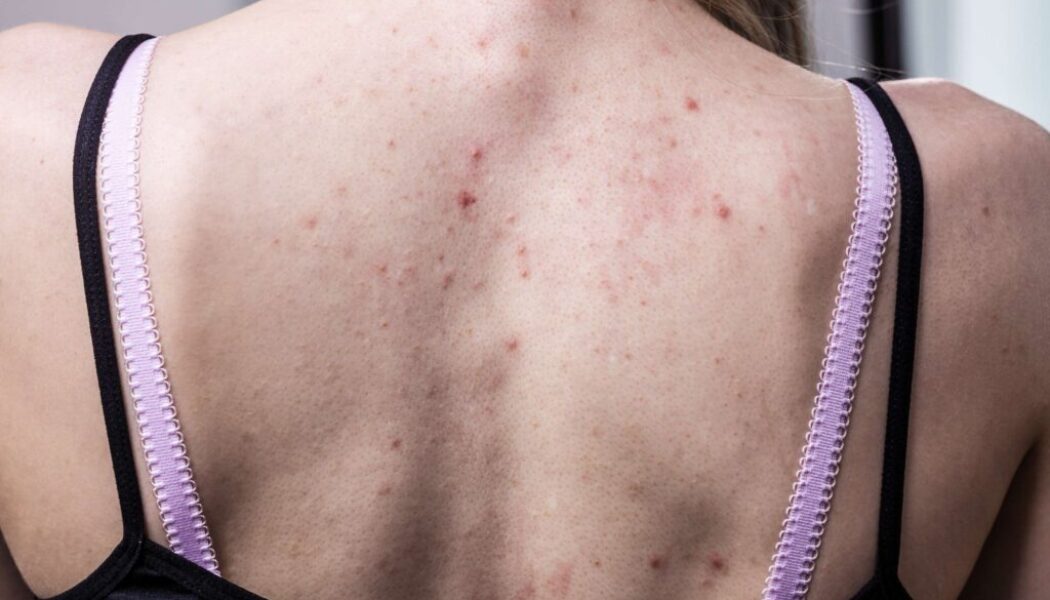 Back Acne: A Common Summer Skin Concern & How to Tackle It