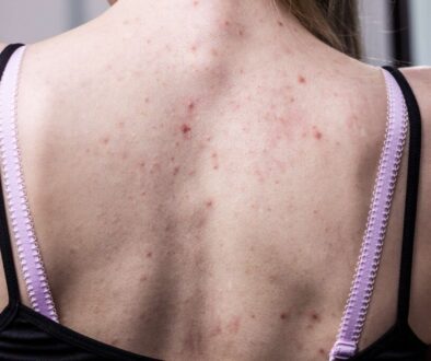 Back Acne