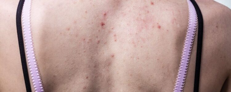 Back Acne: A Common Summer Skin Concern & How to Tackle It