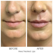 Before_and_After_Lips_1