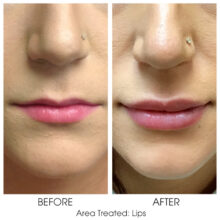 Before_and_After_Lips_10