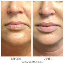 Before_and_After_Lips_11