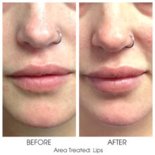 Before_and_After_Lips_12