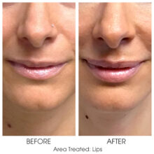 Before_and_After_Lips_2