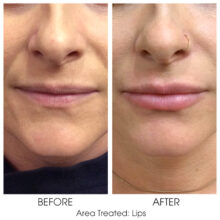 Before_and_After_Lips_3