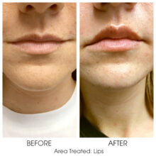 Before_and_After_Lips_4