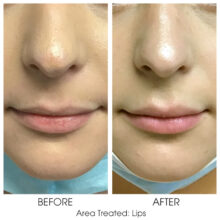 Before_and_After_Lips_5