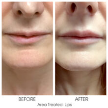 Before_and_After_Lips_6