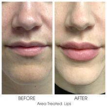 Before_and_After_Lips_7