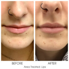 Before_and_After_Lips_8