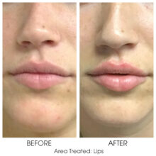 Before_and_After_Lips_9