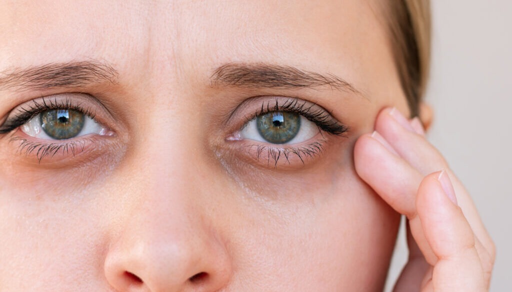 Close up of young woman with dark circles under her eyes.