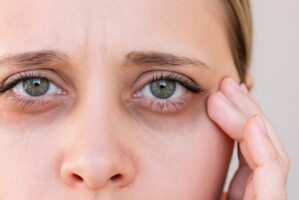 Close up of young woman with dark circles under her eyes.