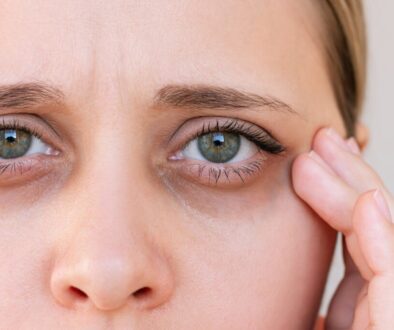 Close up of young woman with dark circles under her eyes.