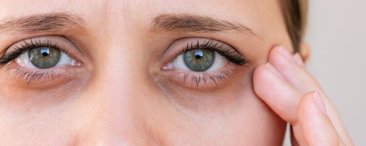 Best Treatment for Under Eye Bags, Dark Circles & Tired Eyes in York & Hanover, PA