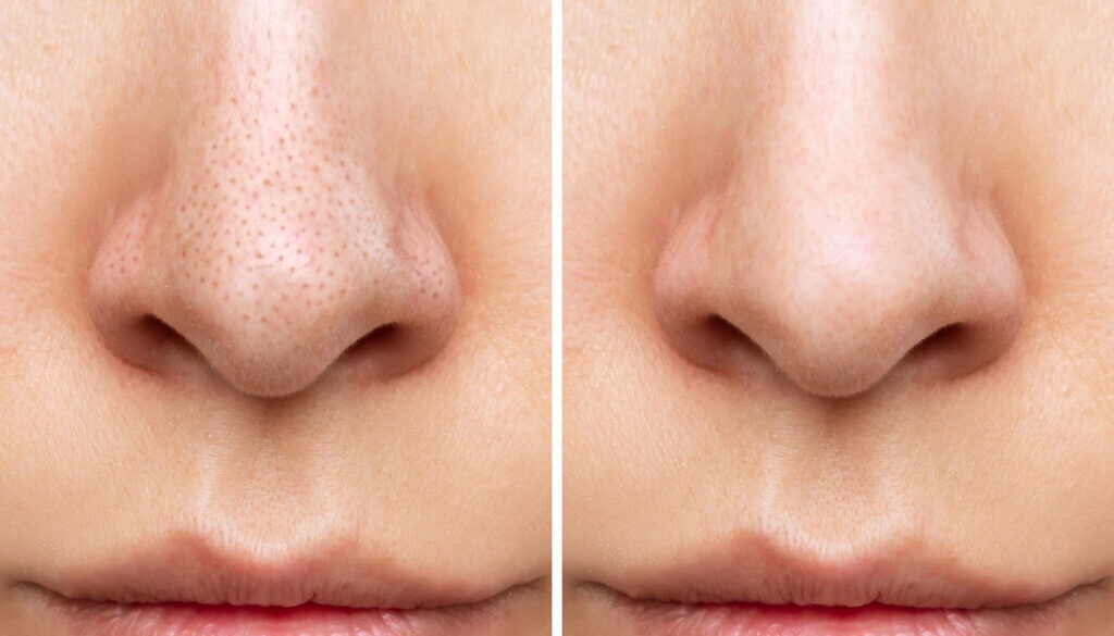 Blackheads