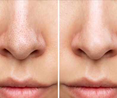 Blackheads