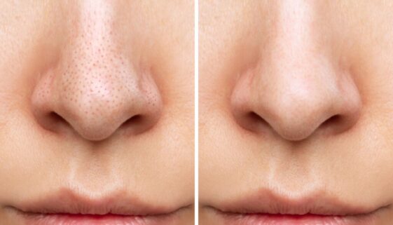 Blackheads