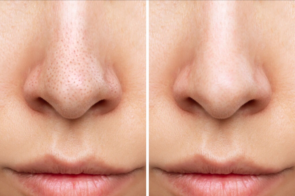 Blackheads