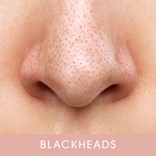 Blackheads