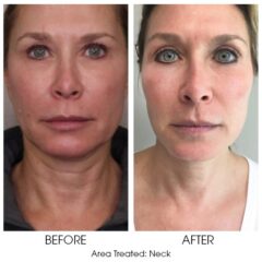 Smooth Threads for Necklace Lines 2