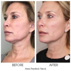 Smooth Threads for Necklace Lines 1