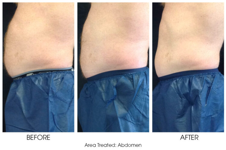 BnA_For_Blogs_3wide_01 Coolsculpting for Men