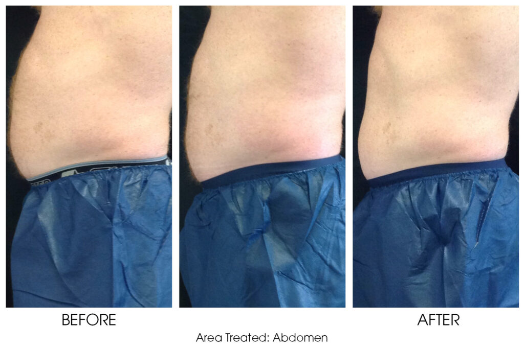 Coolsculpting for Men