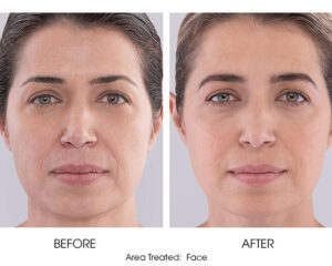 Sculptra