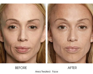 Sculptra