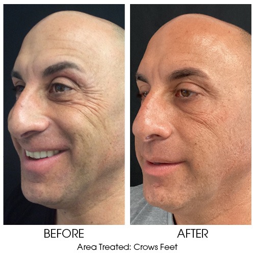 BnA_For_Tox_crowsfeet Brotox