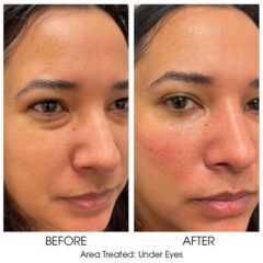 Ariessence Pure PDGF+ for Injections
