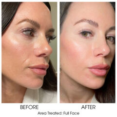 Ariessence Pure PDGF+ for Injections