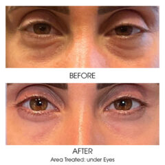Ariessence Pure PDGF+ for Injections