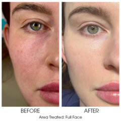 Ariessence Pure PDGF+ for Microneedling