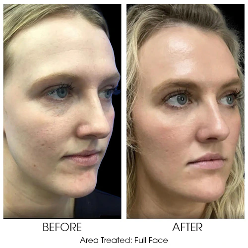 BnA_For_ariessence_MN_02 PDGF with microneedling