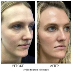 Ariessence Pure PDGF+ for Microneedling