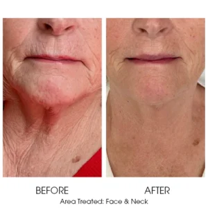 MICRONEEDLING with PDGF