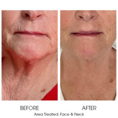 Ariessence Pure PDGF+ for Microneedling