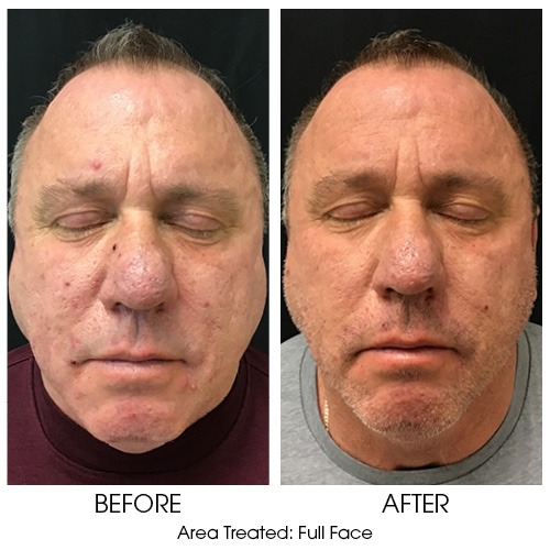 BnA_For_chempeel Chemical Peels for Men