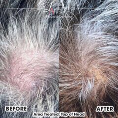 microneedling with exosomes