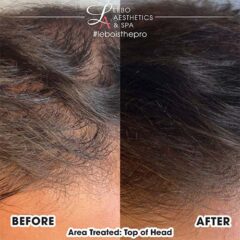 exosomes for hair restoration